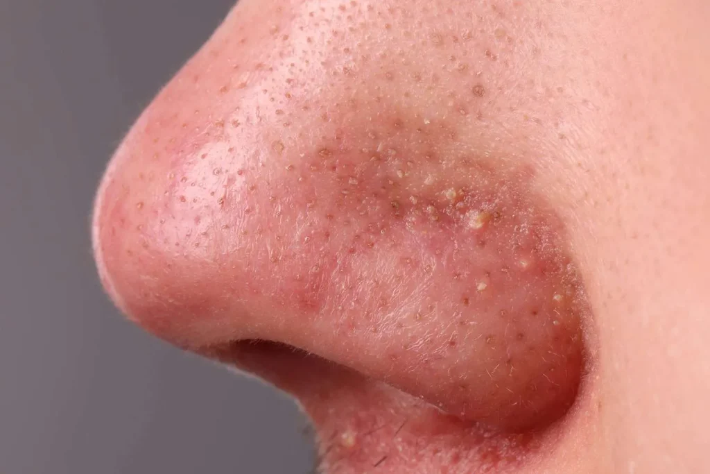 nose-pimples-hidden-causes-and-fast-cures-4-1024x683.webp