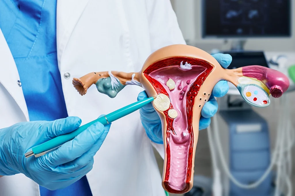 میوم رحم چیست؛ علائم، عوارض و روش‌های درمان فیبروم رحم