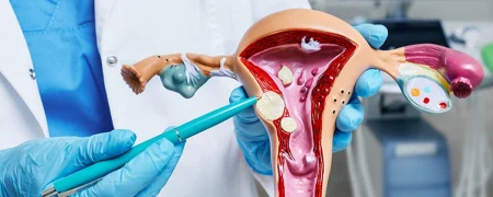 میوم رحم چیست؛ علائم، عوارض و روش‌های درمان فیبروم رحم