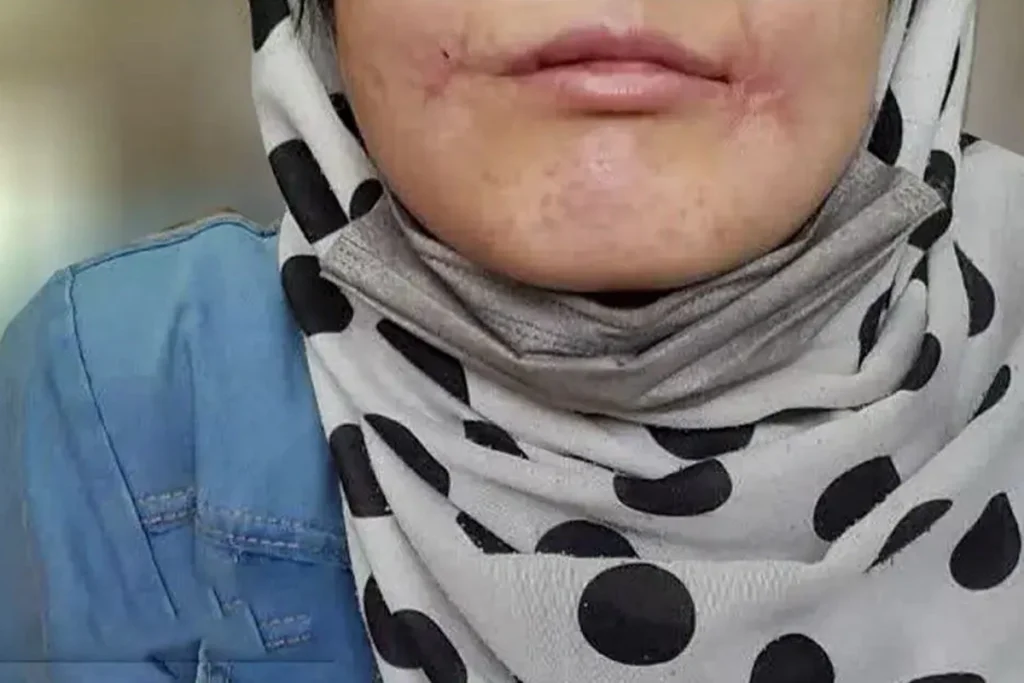 روایت هولناک زن جوان از یک سال شکنجه در مشهد: شوهرم لب‌هایم را با نخ و سوزن دوخت