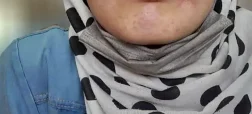شوهر معتاد لب‌های همسر ۱۸ ساله‌اش را با نخ و سوزن دوخت