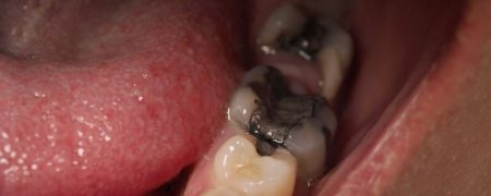 همه چیز درباره پر کردن دندان با آمالگام