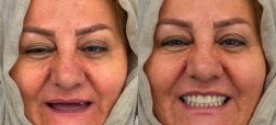 تفاوت دندان مصنوعی و اوردنچر