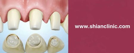 قیمت روکش دندان 1405 چقدر است؟