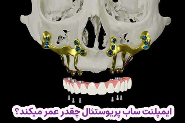 ایمپلنت ساب پریوستئال چقدر عمر میکند؟ بررسی عوامل تاثیرگذار