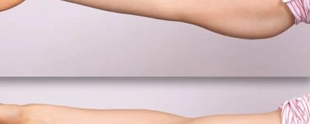 براکیوپلاستی یا لیفت بازو چیست؟ از انواع و مزایا گرفته تا عوارض و نکات مهم