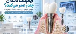 طول عمر ایمپلنت دندان